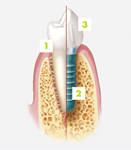 Dental Implants Norwich